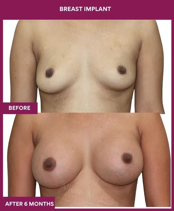 breast-implant-before-after-results-mumbai-patient02-front