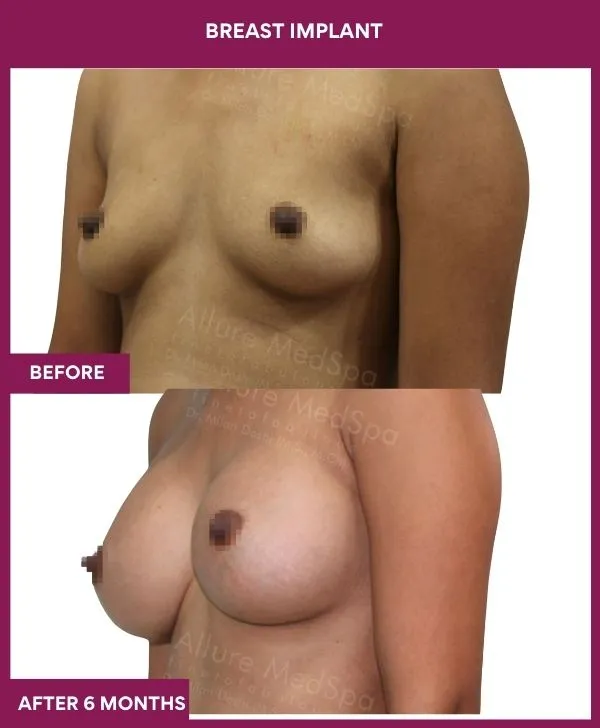 breast-implant-before-after-results-mumbai-patient02-side-left