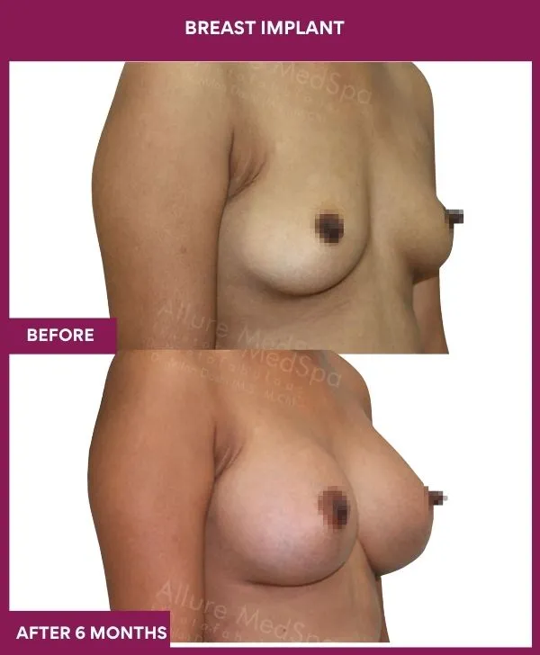 breast-implant-before-after-results-mumbai-patient02-side-right