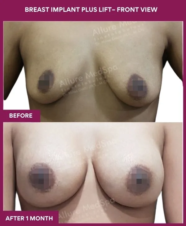 breast-implant-with-lift-before-after-results-mumbai-patient01-front