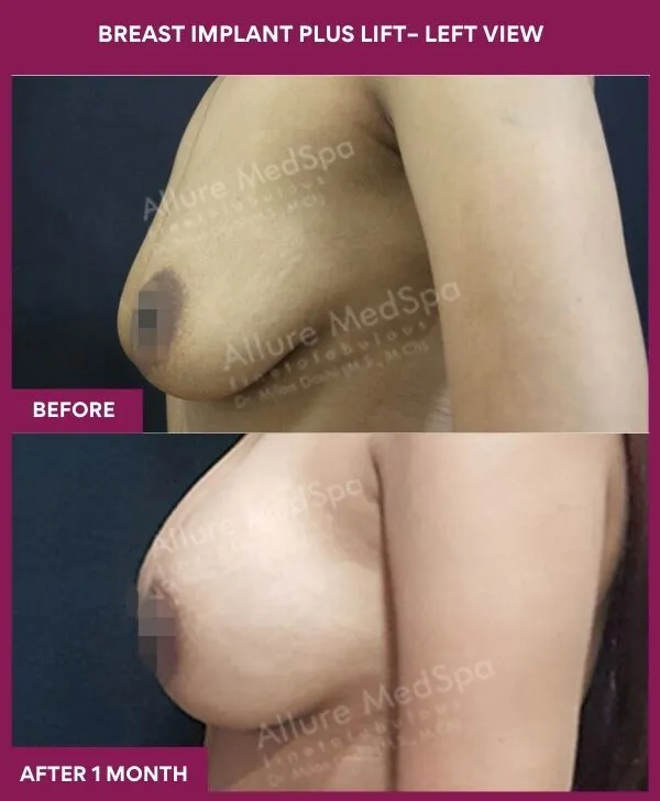 breast-implant-with-lift-before-after-results-mumbai-patient01-side-left