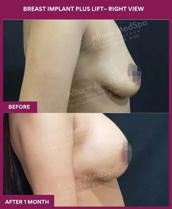 breast-implant-with-lift-before-after-results-mumbai-patient01-side-right