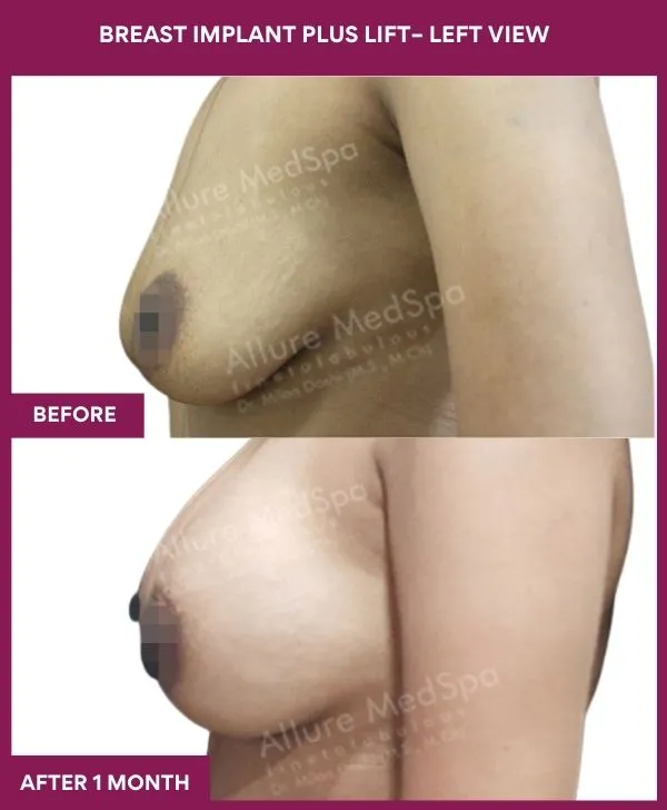 breast-lift-surgery-before-after-results-mumbai-india-patient01-side-left