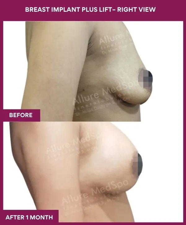 breast-lift-surgery-before-after-results-mumbai-india-patient01-side-right