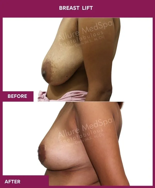 breast-lift-surgery-before-after-results-mumbai-india-patient02-side-left