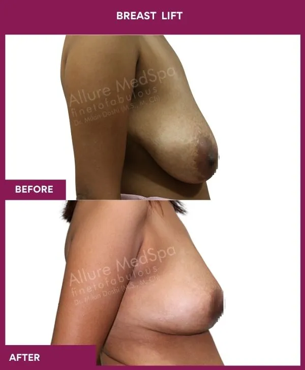 breast-lift-surgery-before-after-results-mumbai-india-patient02-side-right