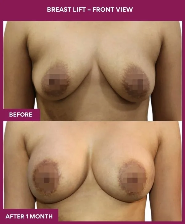 breast-lift-surgery-before-after-results-mumbai-india-patient03-front