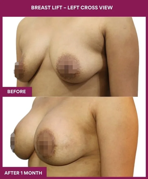 breast-lift-surgery-before-after-results-mumbai-india-patient03-side-left
