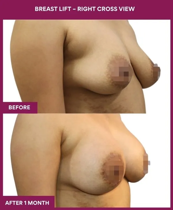 breast-lift-surgery-before-after-results-mumbai-india-patient03-side-right