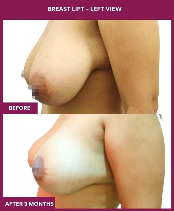 breast-lift-surgery-before-after-results-mumbai-india-patient04-side-left