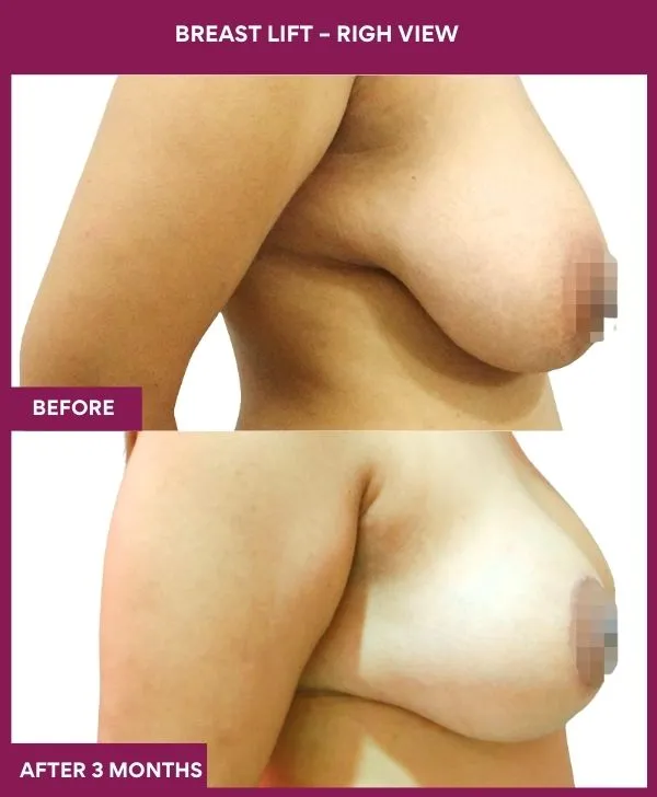 breast-lift-surgery-before-after-results-mumbai-india-patient04-side-right