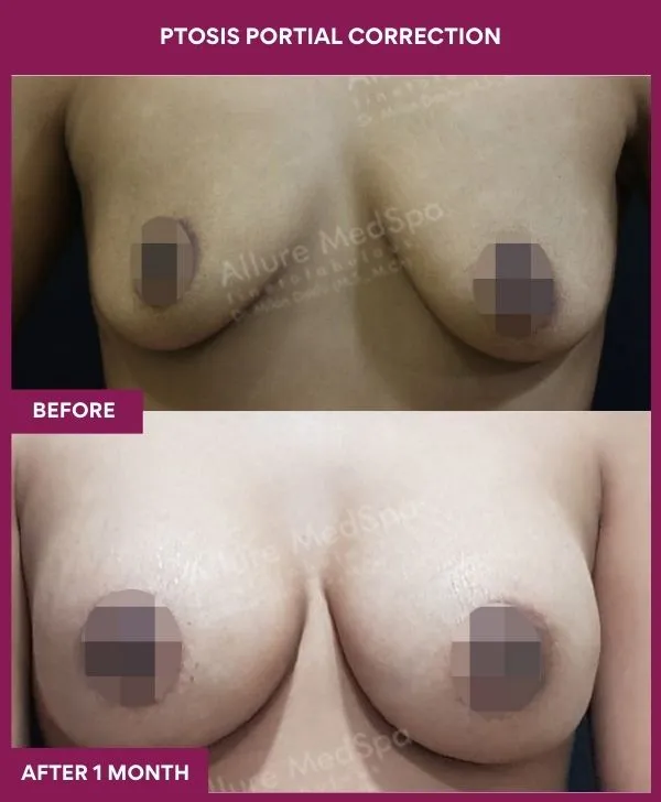 breast-ptosis-correction-before-after-results-mumbai-india-patient01-front