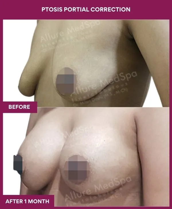 breast-ptosis-correction-before-after-results-mumbai-india-patient01-side-left