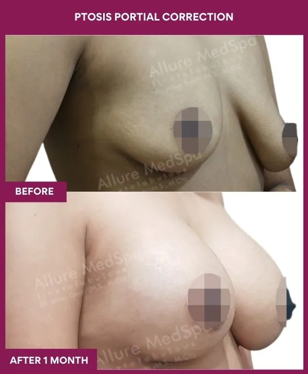 breast-ptosis-correction-before-after-results-mumbai-india-patient01-side-right