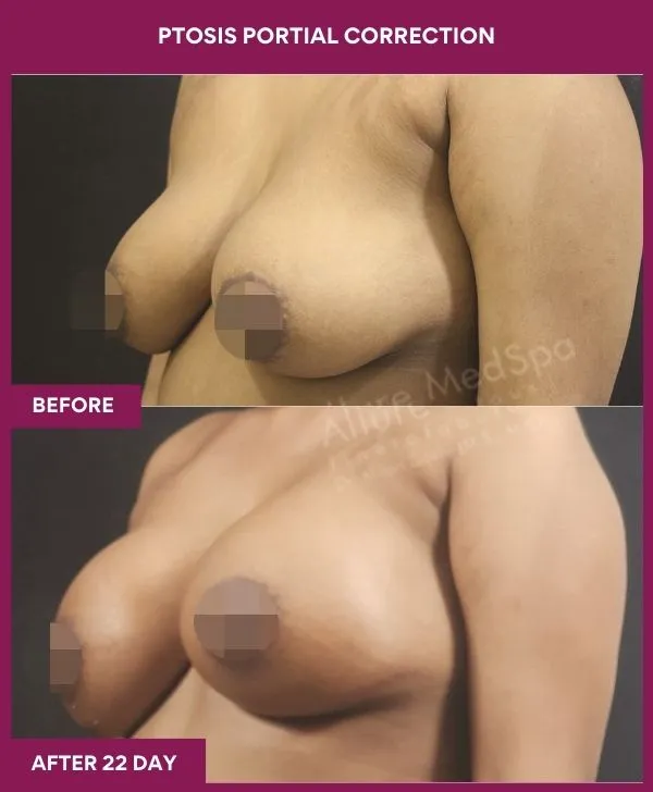 breast-ptosis-correction-before-after-results-mumbai-india-patient02-side-left