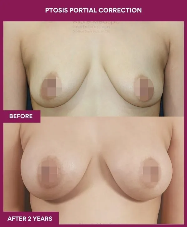 breast-ptosis-correction-before-after-results-mumbai-india-patient03-front