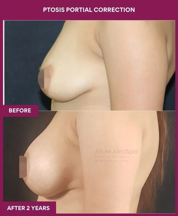 breast-ptosis-correction-before-after-results-mumbai-india-patient03-side-left