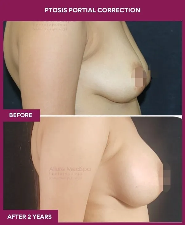 breast-ptosis-correction-before-after-results-mumbai-india-patient03-side-right