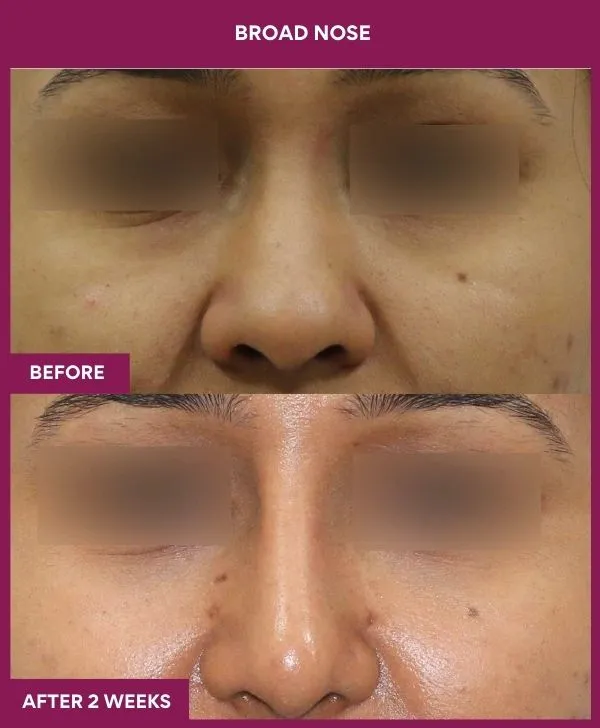 broad-nose-before-after-results-mumbai-india-patient01-front