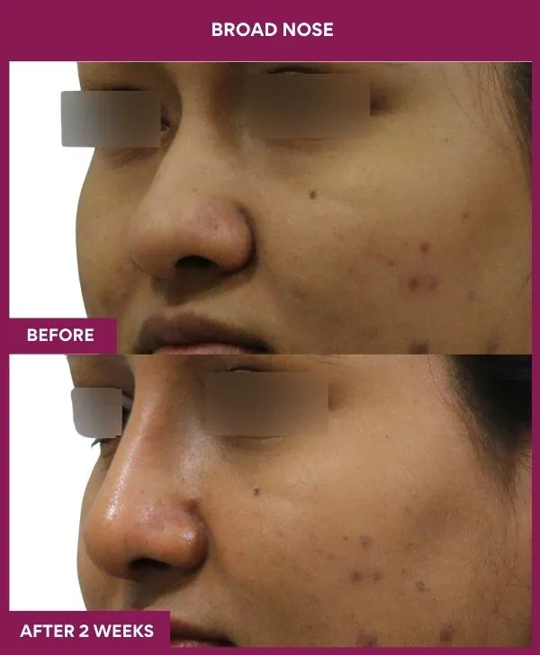 broad-nose-before-after-results-mumbai-india-patient01-side-left