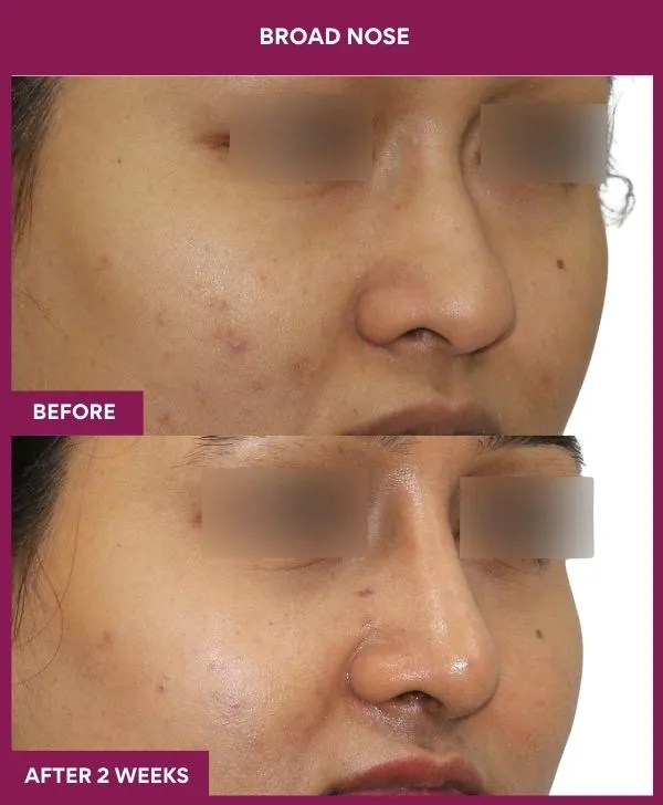 broad-nose-before-after-results-mumbai-india-patient01-side-right