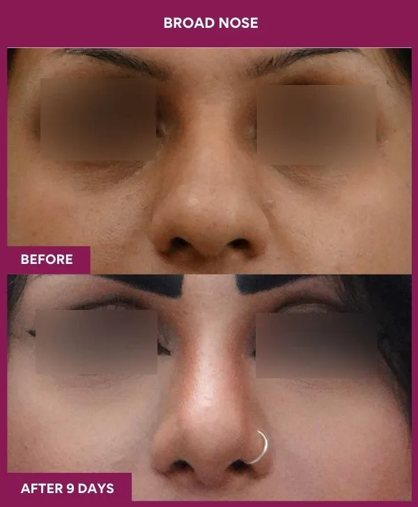 broad-nose-rhinoplasty-before-after-results-mumbai-india-patient03-front