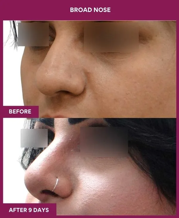 broad-nose-rhinoplasty-before-after-results-mumbai-india-patient03-side-left