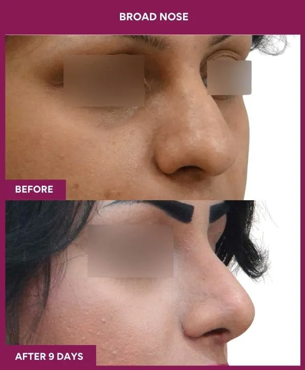 broad nose rhinoplasty before after results mumbai patient03 side right