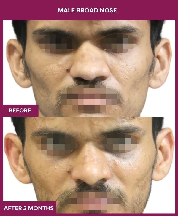 broad-nose-rhinoplasty-before-after-results-mumbai-india-patient04-front