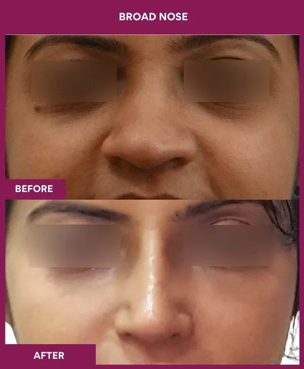 broad nose rhinoplasty before after results mumbai patient05 front
