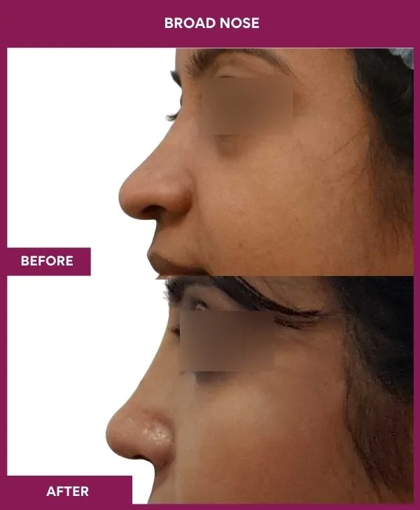 broad-nose-rhinoplasty-before-after-results-mumbai-india-patient05-side-left
