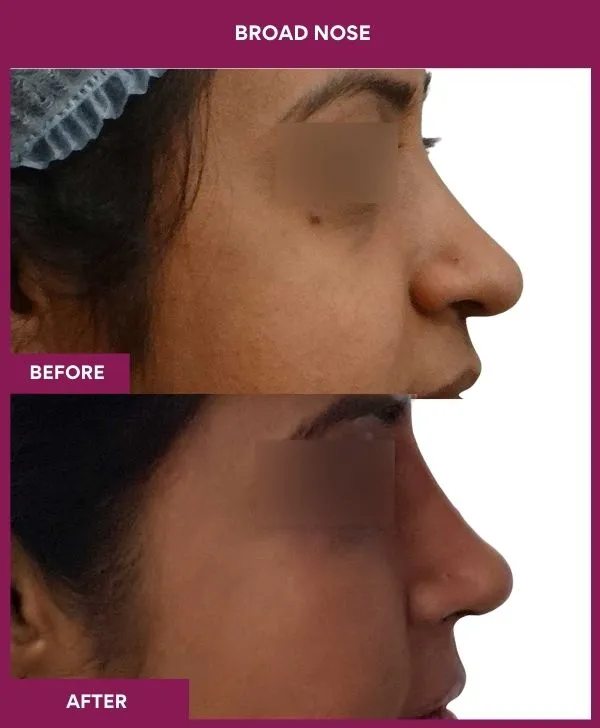 broad nose rhinoplasty before after results mumbai patient05 side right