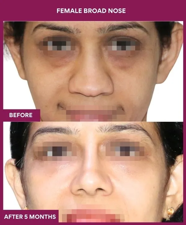 broad-nose-rhinoplasty-before-after-results-mumbai-india-patient06-front