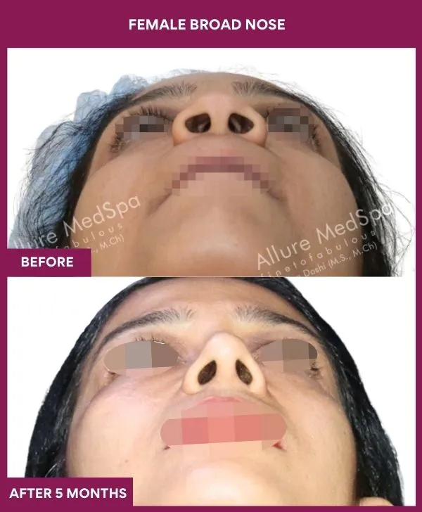 broad-nose-rhinoplasty-before-after-results-mumbai-india-patient06-side-front-up
