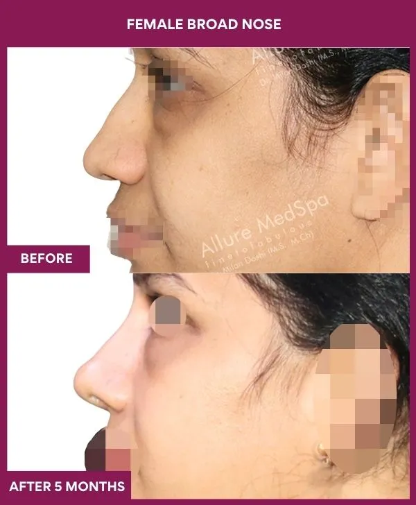 broad-nose-rhinoplasty-before-after-results-mumbai-india-patient06-side-left