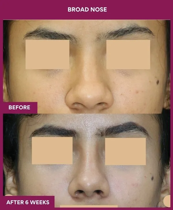 broad nose rhinoplasty before after results mumbai patient07 front