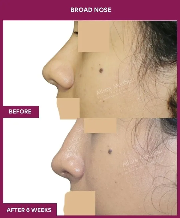 broad nose rhinoplasty before after results mumbai patient07 side left