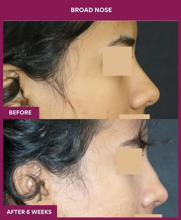broad nose rhinoplasty before after results mumbai patient07 side right