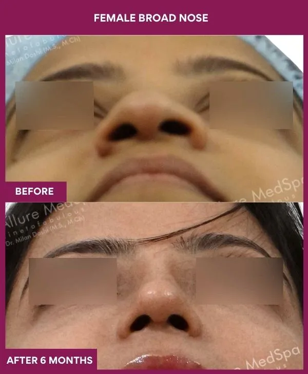 broad-nose-rhinoplasty-before-after-results-mumbai-india-patient08-front-up