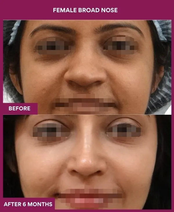broad-nose-rhinoplasty-before-after-results-mumbai-india-patient08-front