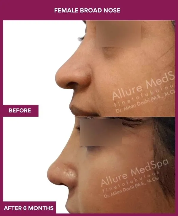 broad-nose-rhinoplasty-before-after-results-mumbai-india-patient08-side-left