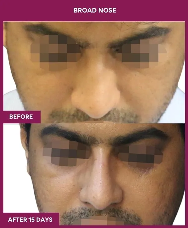 broad-nose-rhinoplasty-before-after-results-mumbai-india-patient10-front-down