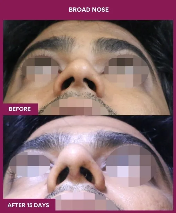 broad nose rhinoplasty before after results mumbai patient10 front up 1