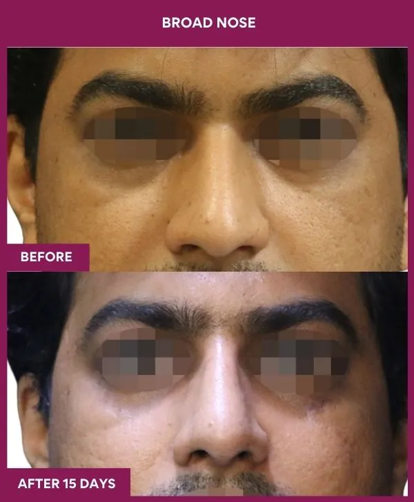 broad-nose-rhinoplasty-before-after-results-mumbai-india-patient10-front