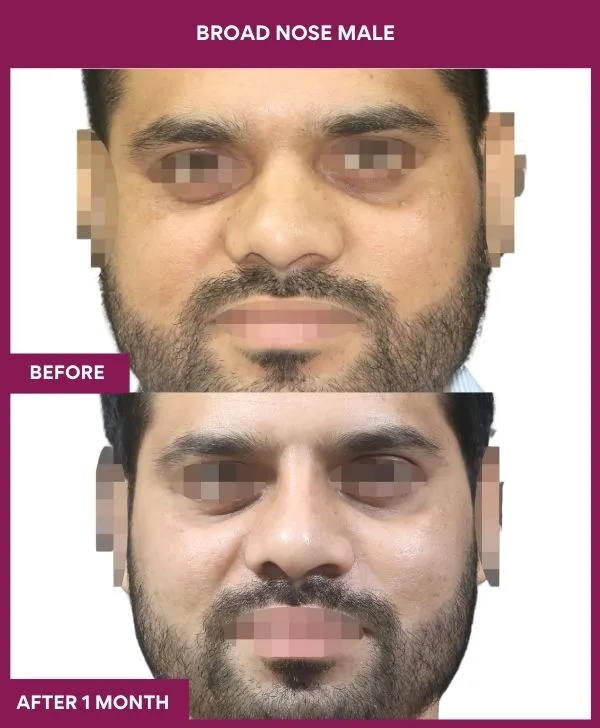 broad nose rhinoplasty before after results mumbai patient11 front
