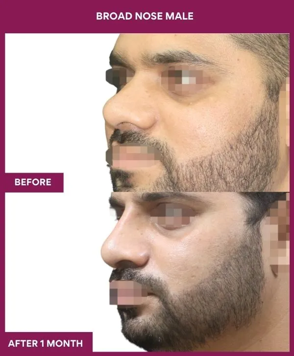 broad nose rhinoplasty before after results mumbai patient11 side left