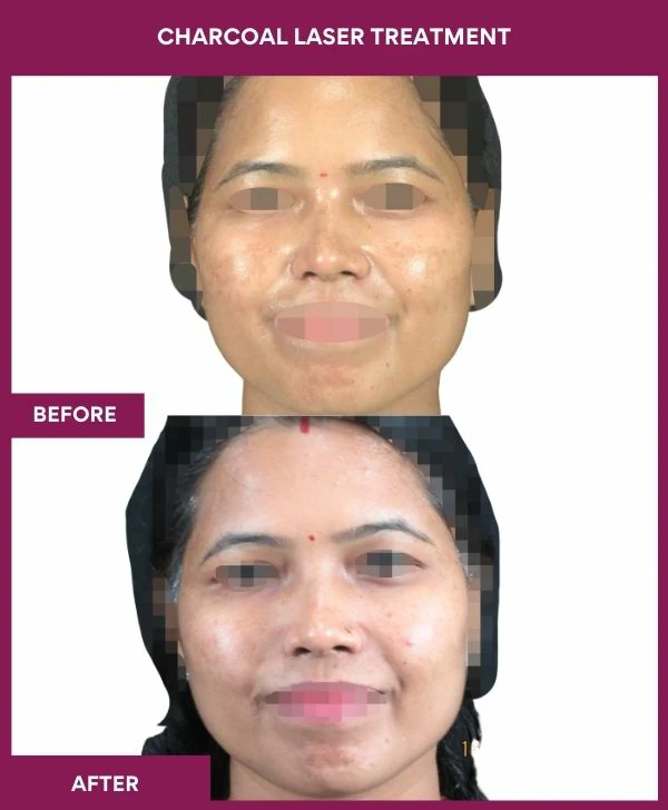 carbon-laser-treatment-before-after-results-mumbai-india-patient01-front