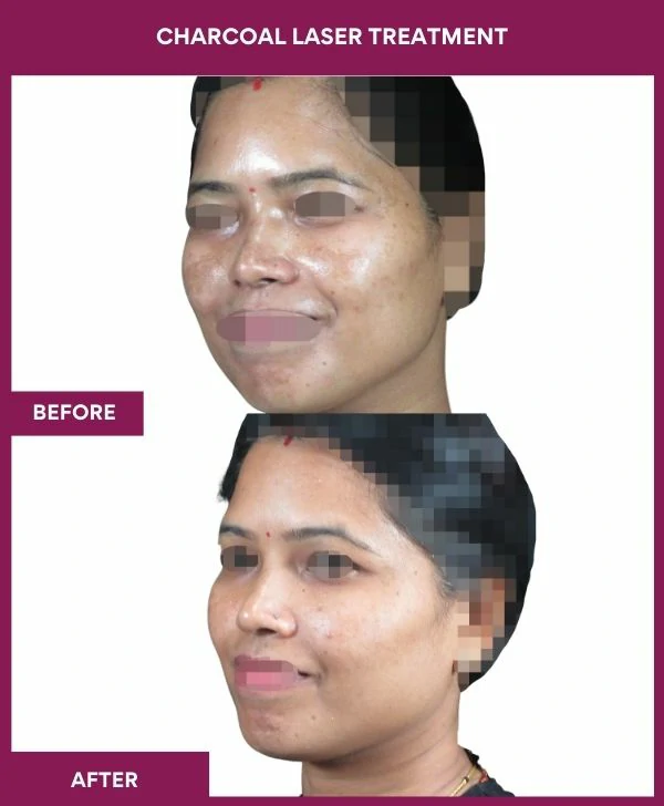 carbon-laser-treatment-before-after-results-mumbai-india-patient01-side-left