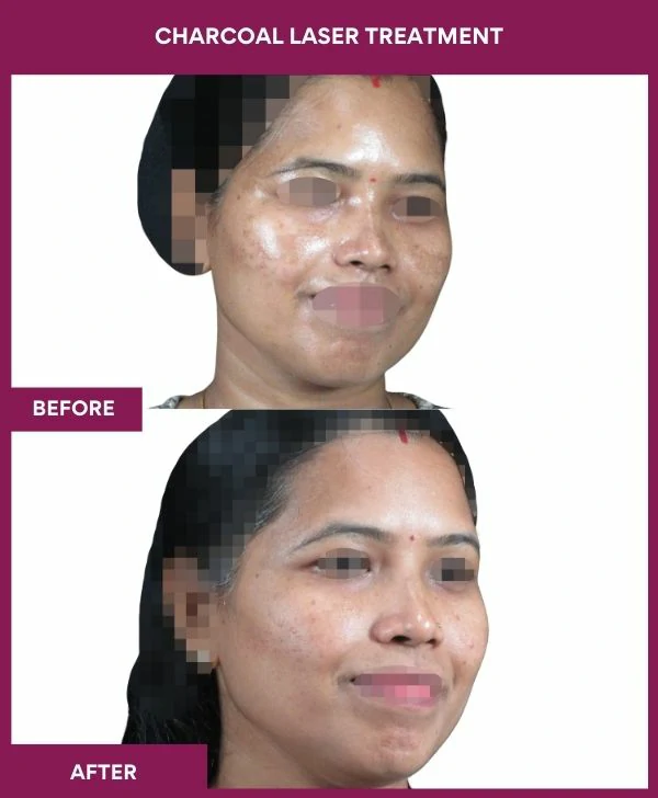 carbon-laser-treatment-before-after-results-mumbai-india-patient01-side-right