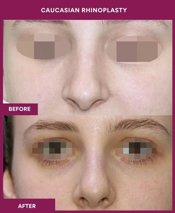 caucasian-rhinoplasty-surgery-before-after-results-mumbai-india-patient01-front